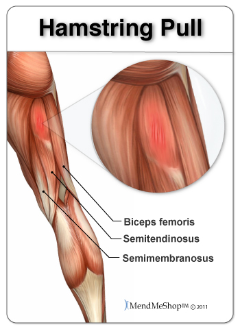 hamstring-pull-biceps-femoris